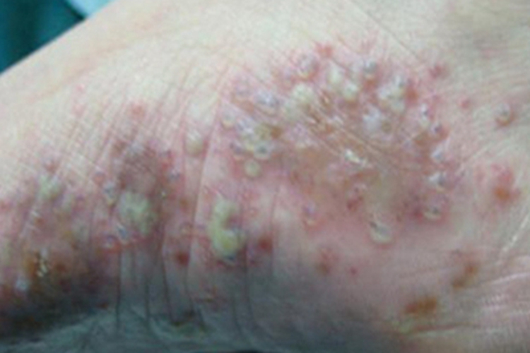 角层下脓疱性皮病红斑图 角层下脓疱性皮病红斑图