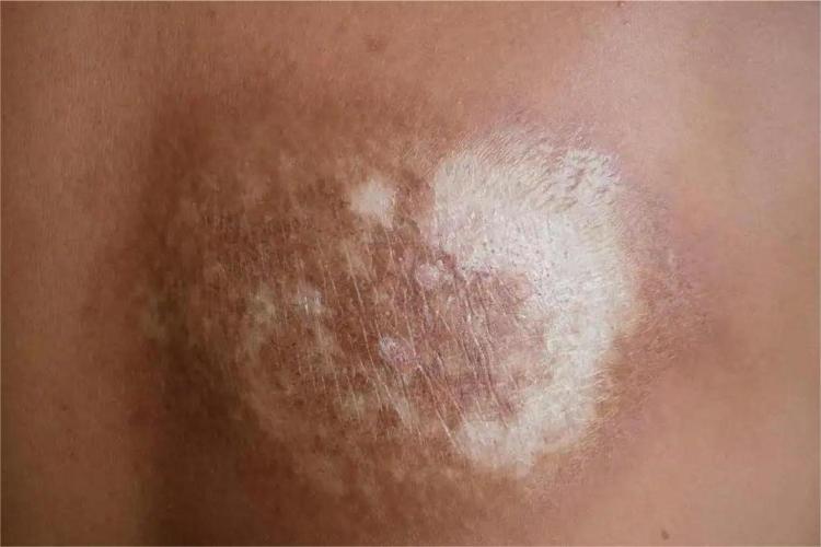 斑片状硬化萎缩性苔藓图