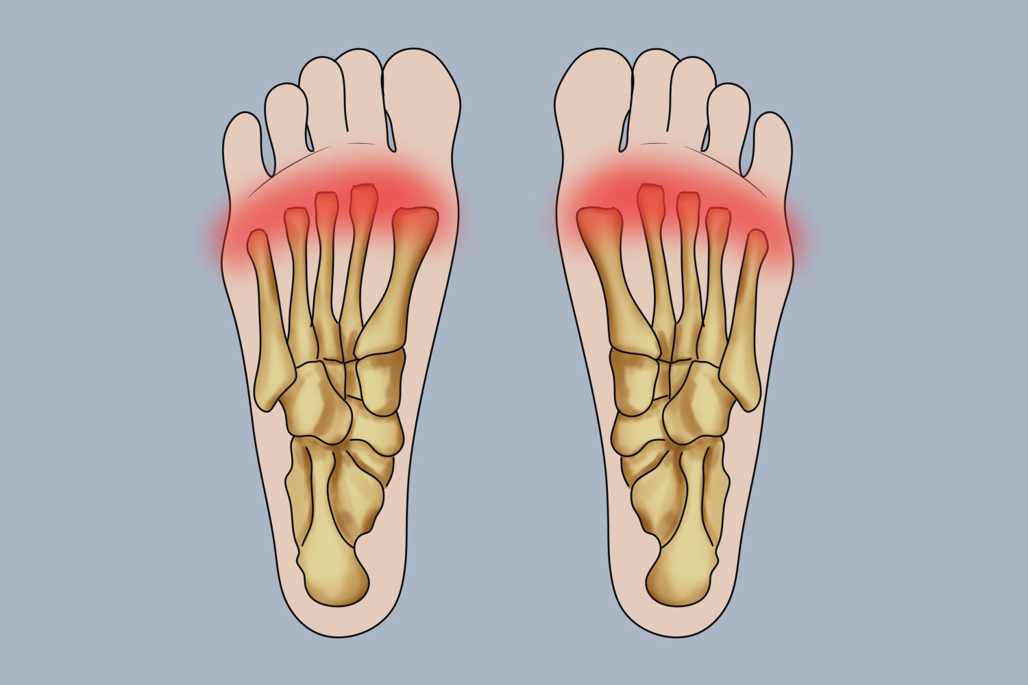 跖痛症的疼痛位置示意图