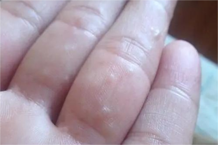 手指水疱型手癣图