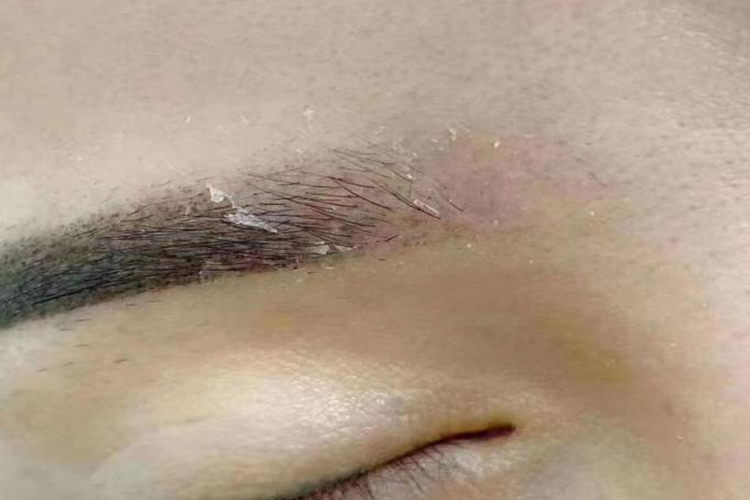 纹眉术后结痂图