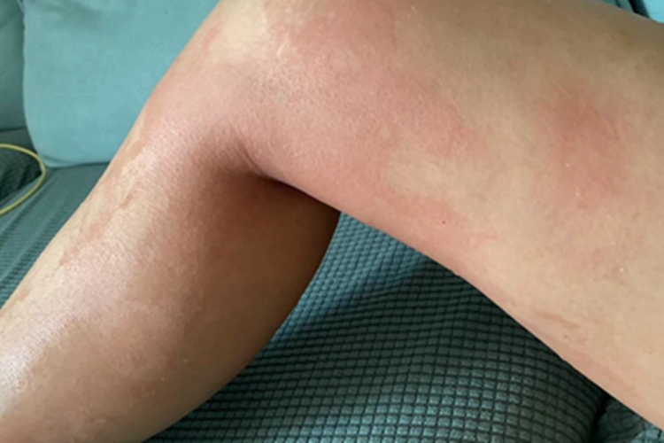 日光性荨麻疹腿症状图