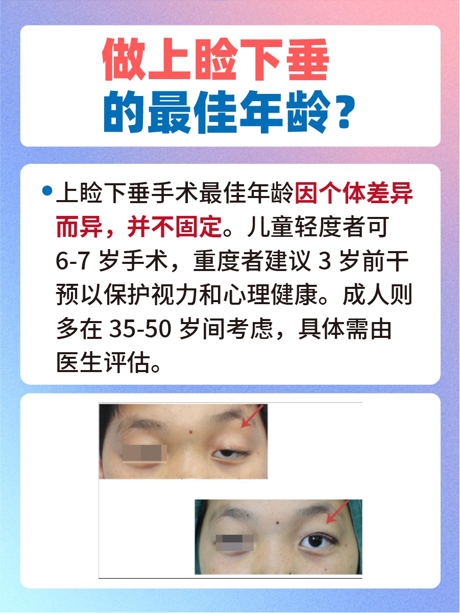 做上睑下垂的最佳年龄:快来围观一下吧