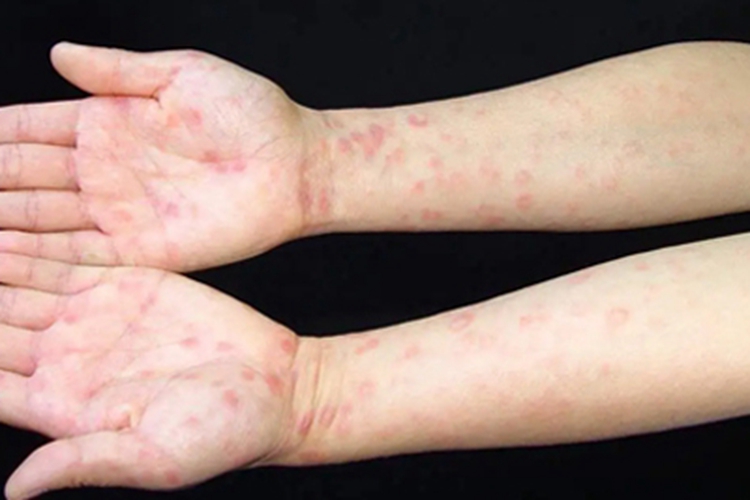 上肢梅毒斑丘疹图