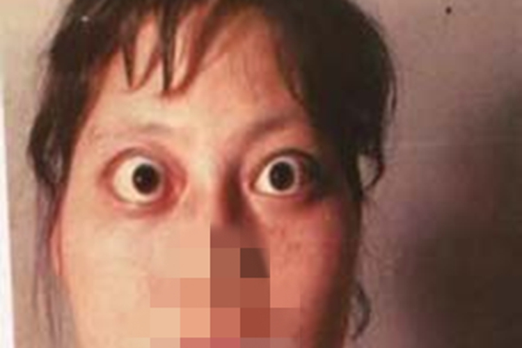 甲状腺功能亢进症双眼突出图