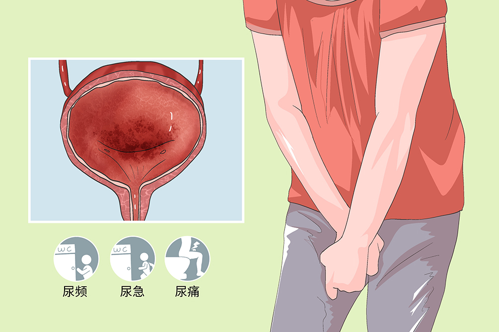 膀胱炎有什么症状早期图片