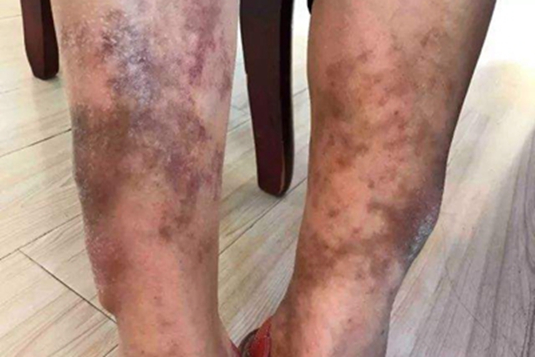 胫前黏液性水肿小腿皮肤发黑图