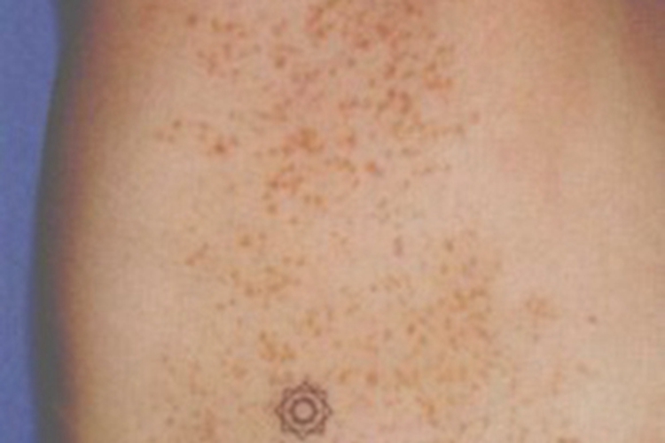 雀斑样痣肋部症状图