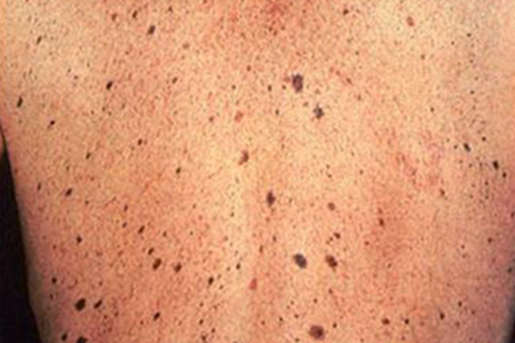 发育不良痣综合征黑斑图