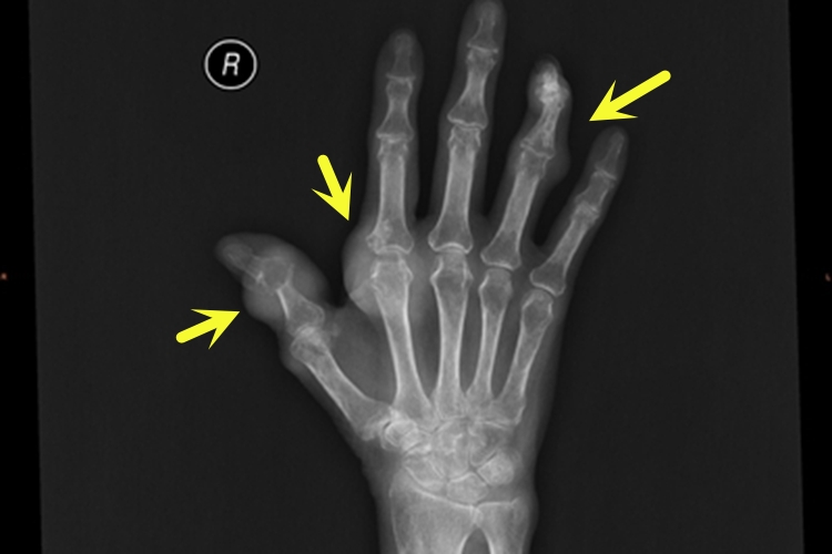 痛风手部肿影像图 痛风手部肿影像图