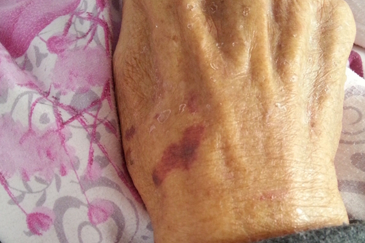 维生素K缺乏症暗红色血斑图