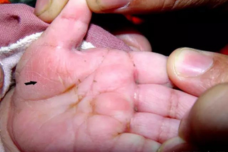 三期梅毒手掌皮肤发红图