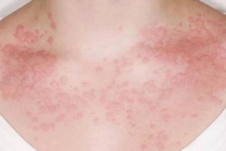 色素性痒疹胸部症状图 色素性痒疹胸部症状图