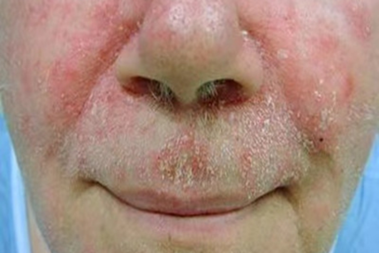 成人脂溢性皮炎面部症状图