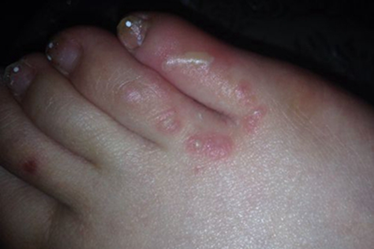 脚趾长水疱颜色发黄图 脚趾长水疱颜色发黄图