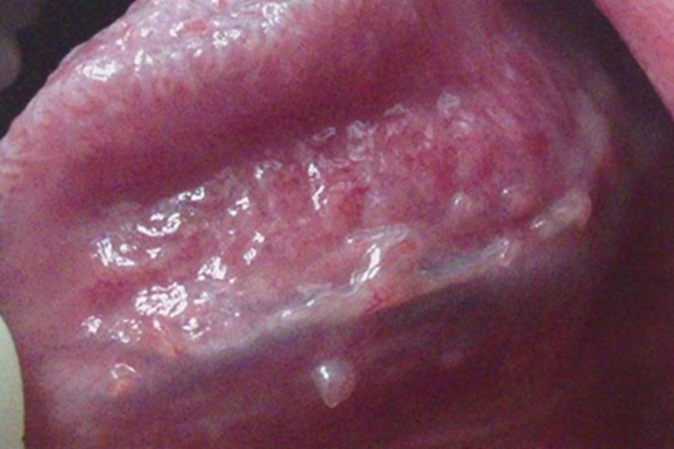 口腔尖锐湿疣舌头肿块图