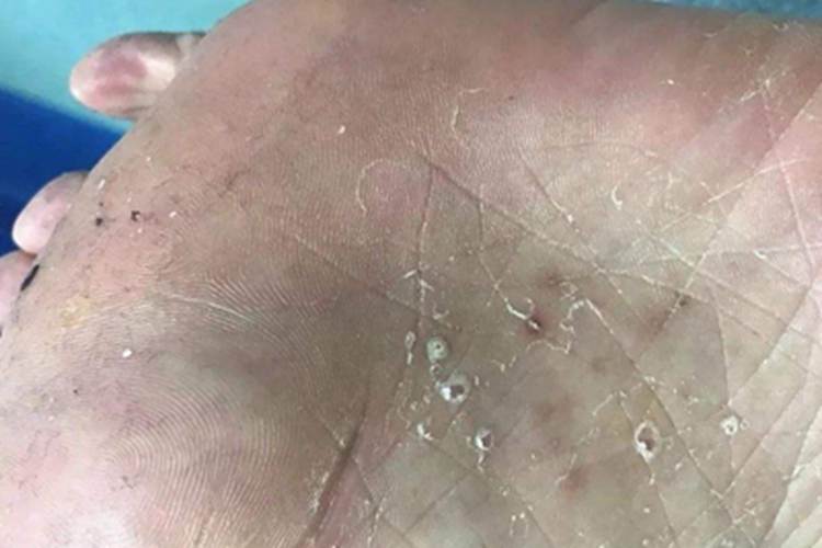 水疱型足癣脚底脱屑图