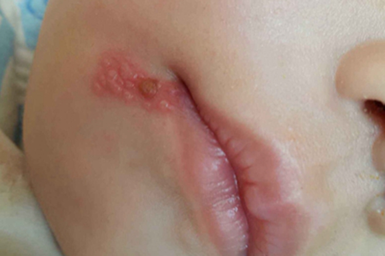 口唇疱疹口周一片红色疱疹图