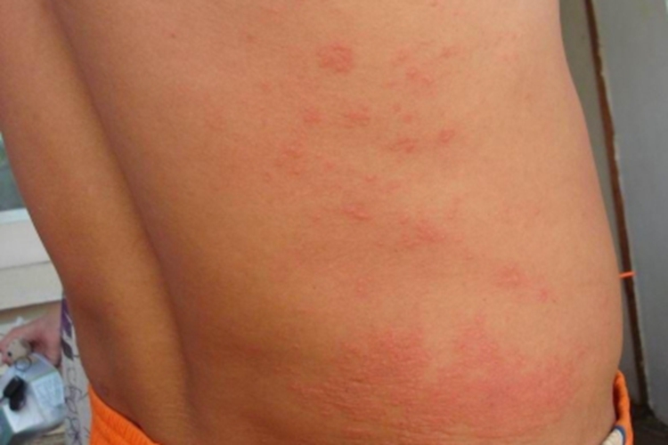 螨虫皮炎腰部疙瘩图