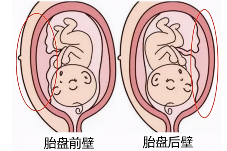 胎盘前壁和胎盘对比图