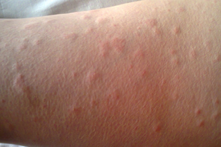 水源性荨麻疹小疙瘩图