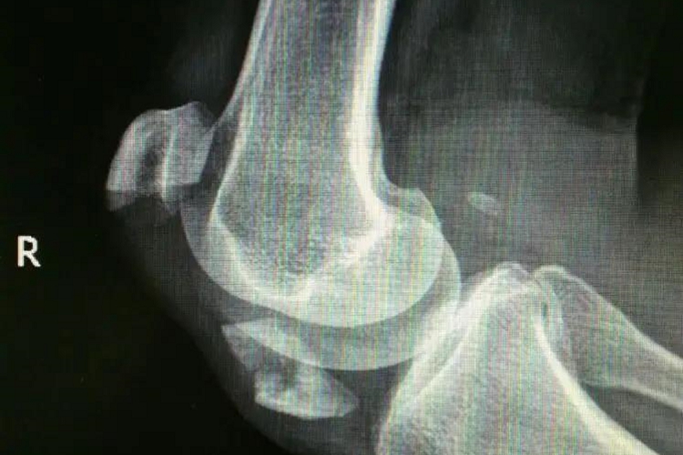 髌骨撕脱性骨折髌骨完全断裂图 髌骨撕脱性骨折髌骨完全断裂图