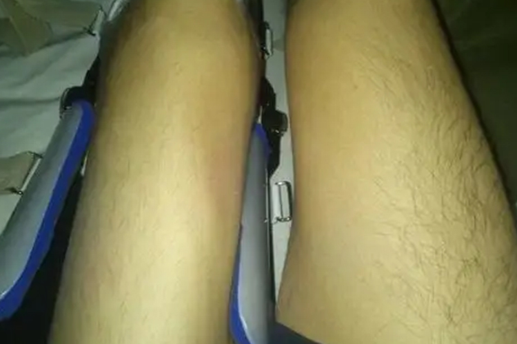 左腿肌肉萎缩变细图 左腿肌肉萎缩变细图