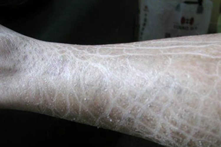 鱼鳞病小腿脱屑图