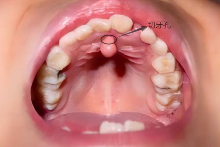 鼻腭囊肿位置图