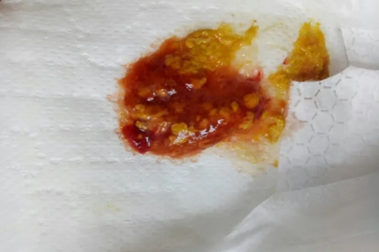 肠道感染大便有血图