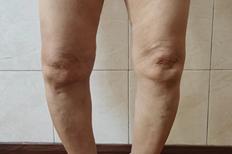 类风湿关节炎腿变形图 类风湿关节炎腿变形图