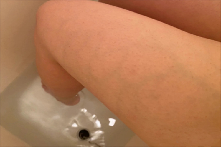 生理性网状青斑大腿症状图