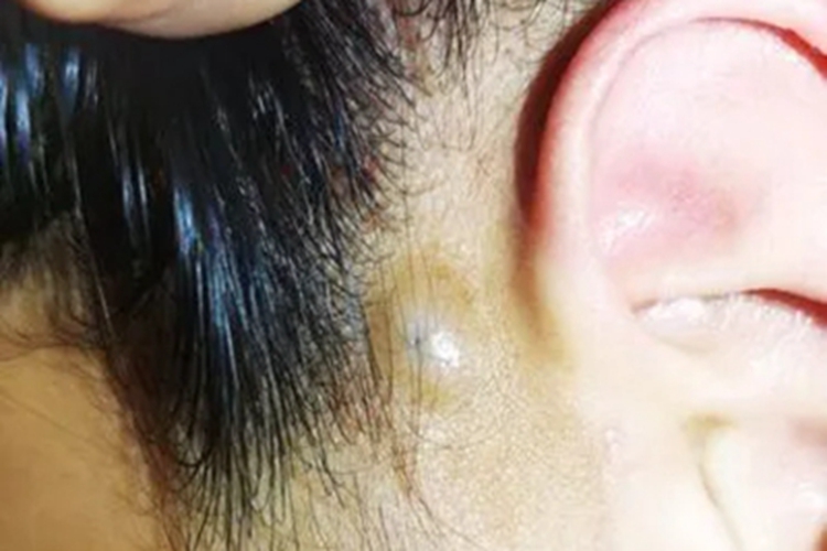 皮脂腺毛囊瘤耳前症状图