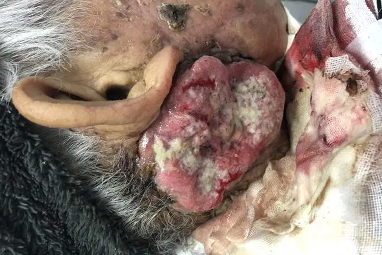 外耳鳞状细胞癌图 外耳鳞状细胞癌图