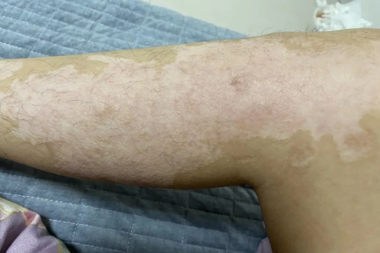 腿部轻度烫伤疤痕图