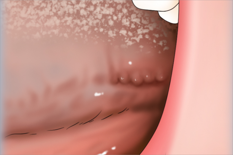 叶状舌乳头炎图