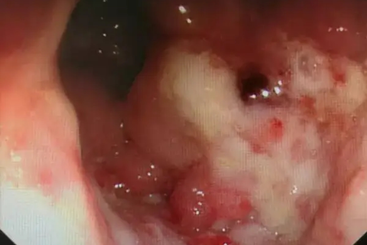 肠镜下肠结核症状图 肠镜下肠结核症状图