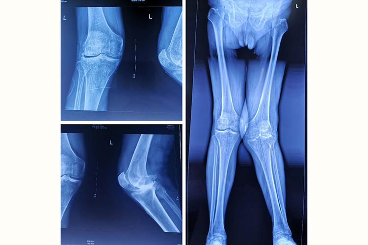 膝盖内扣X线检查图