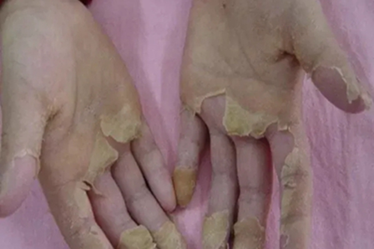 猩红热手部脱皮图