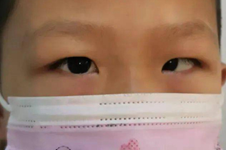 先天性内斜视眼球偏斜图