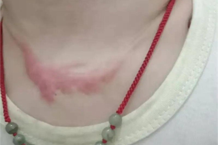 二度烫伤颈部疤痕图