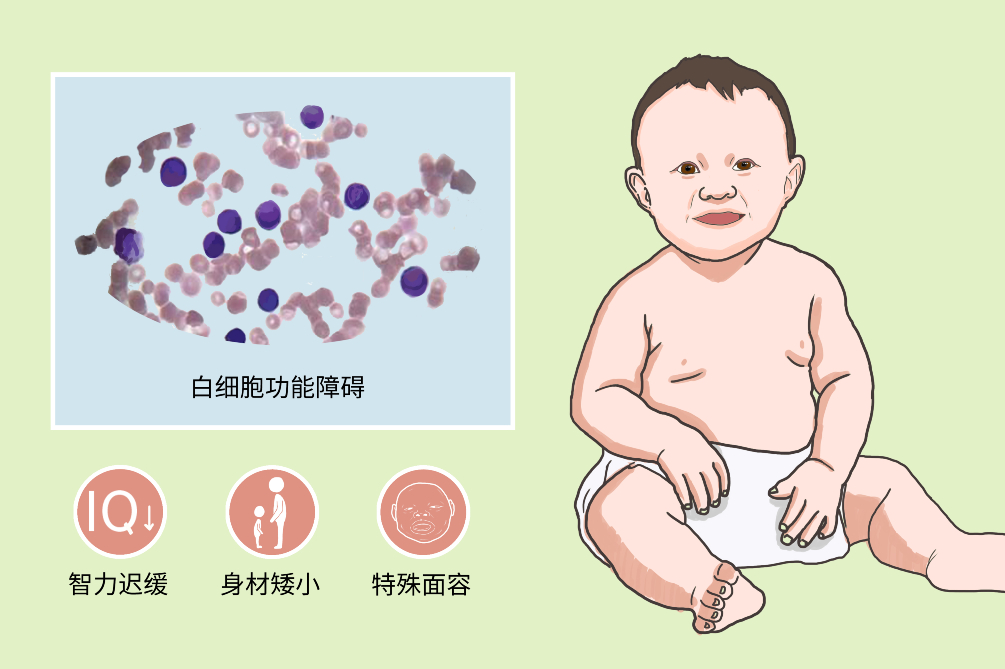 是英文名称:leukocyte adhesion deficiency(Ⅱ)疾病别称:儿童白细胞