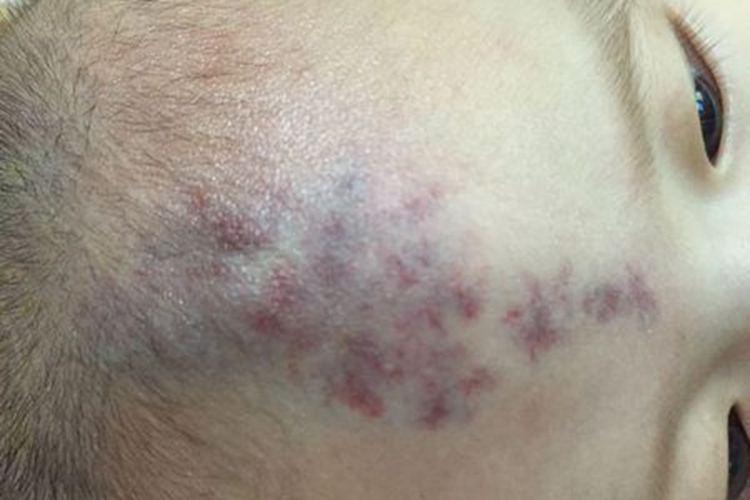 新生儿头部海绵状血管瘤图