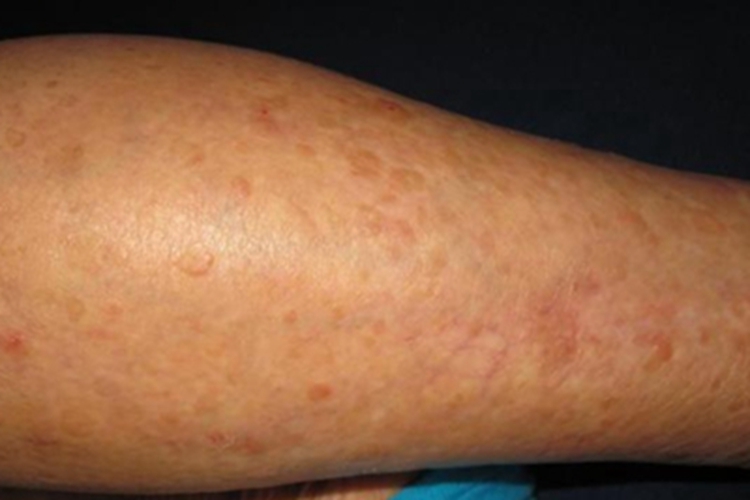 疣状肢端角化病症状图