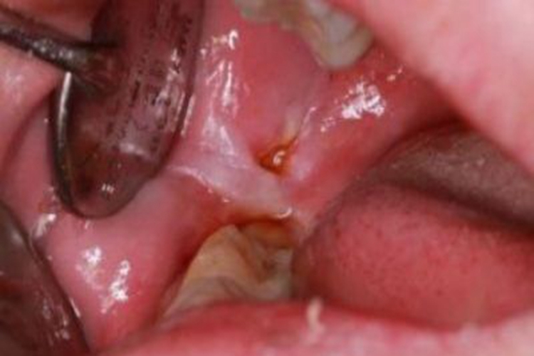 创伤性溃疡口腔溃疡图
