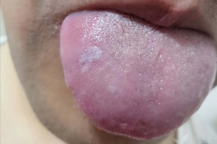 口腔白色角化症图 口腔白色角化症图