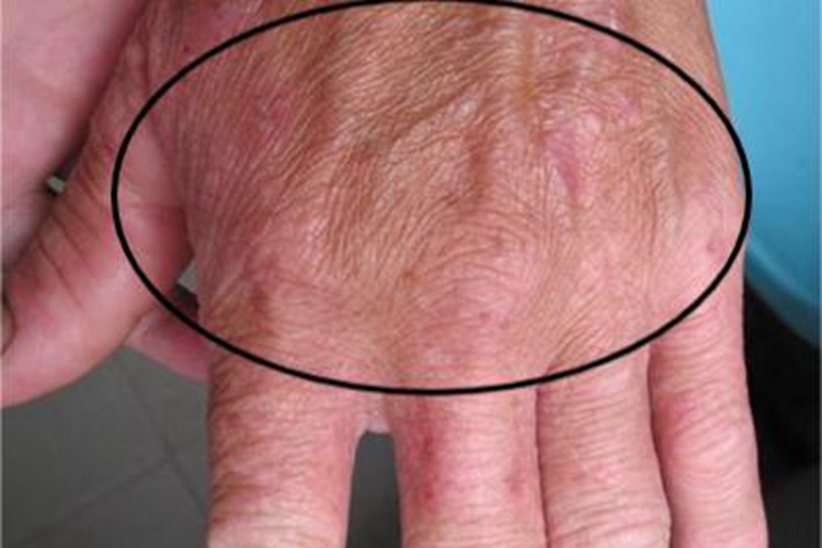 斑块型多形性日光疹手背红斑图