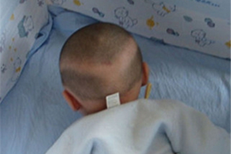 新生儿佝偻病症状图 新生儿佝偻病症状图