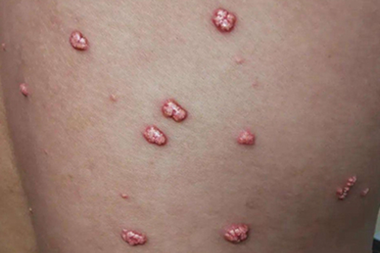 发疹性黄瘤疙瘩图