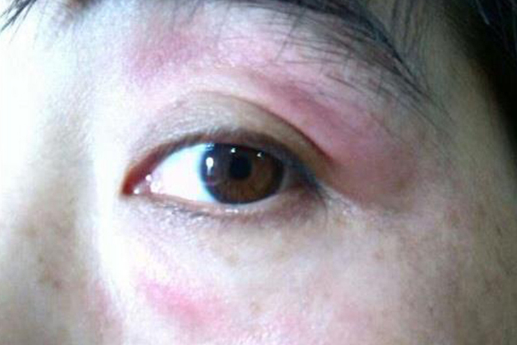 急性接触性皮炎图